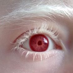 Albinism: How does it affect life of Albino People? < Niruja HealthTech