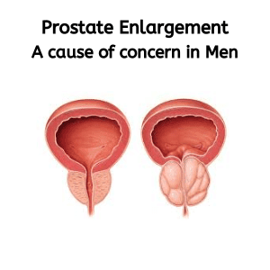 Prostate Enlargement
