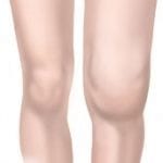 Knee arthritis