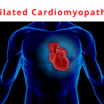 dilated cardiomyopathy