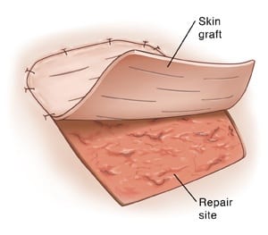 Skin transplant