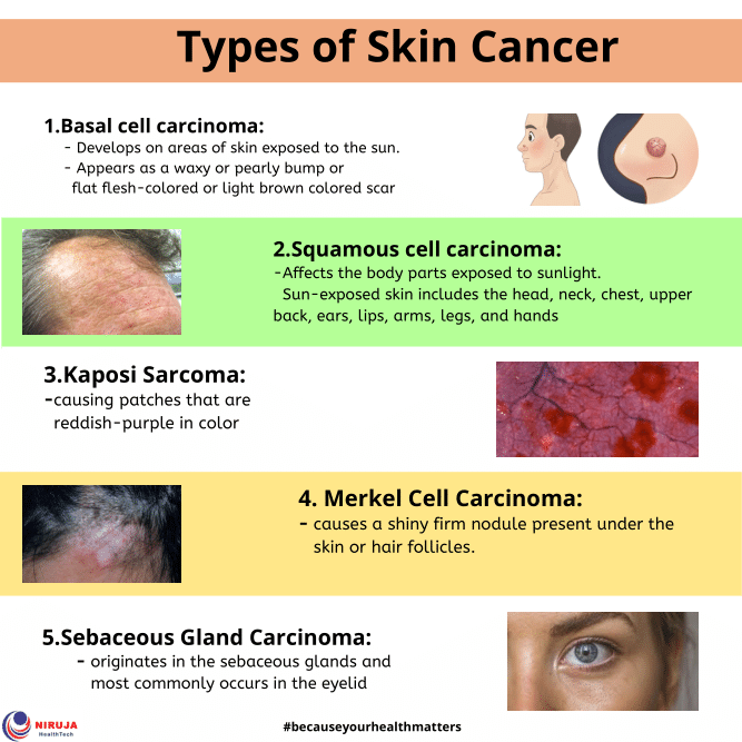 Examples Of Skin Cancer Types