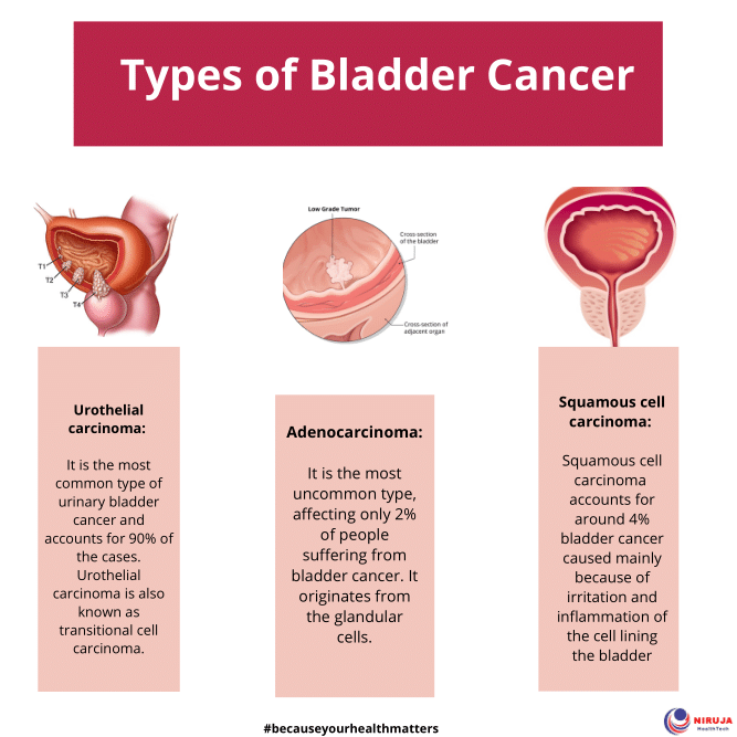 Bladder Cancer Types Infographic