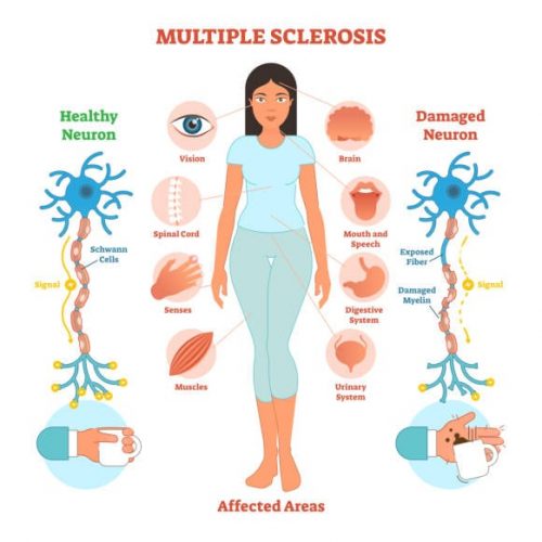 Multiple Sclerosis