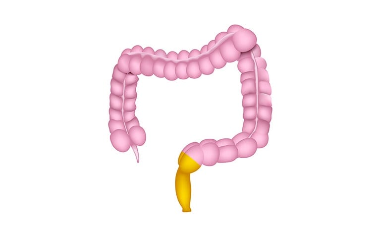 Ulcerative colitis