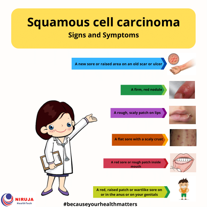 Squamous Cell Throat Cancer Symptoms JIIVCI